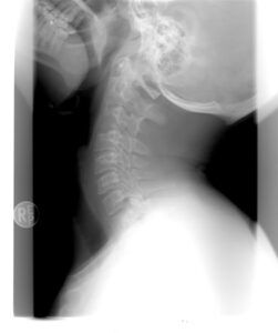Personal Injury Lawyer NYC